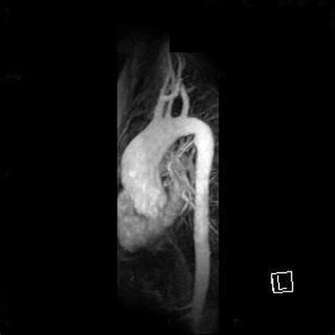 Ascending Aorta Dilatation Aneurysm Radiology Case