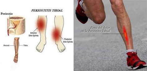 Periostitis Tibial 1 DescripciÓn La Tibia Como El Resto Huesos Está