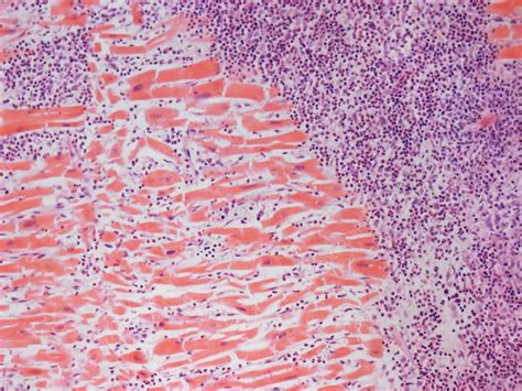 Sep 28, 2021 · myocarditis is inflammation of the heart muscle and is most often seen in relation to a viral infection. Eosinophilic myocarditis, LM - Stock Image - C050/8863 ...