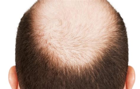 Stages Of Male Pattern Baldness Bald Talk