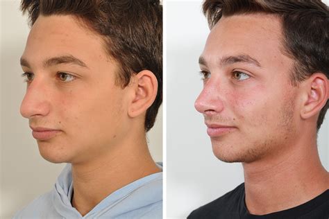 Rhinoplasty Nose Surgery Nose Job For Men In New York City David