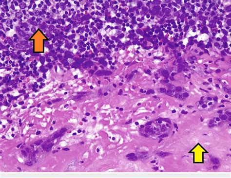 Pathological Histology Of Squamous Cell Carcinoma Lymph Node Biopsy