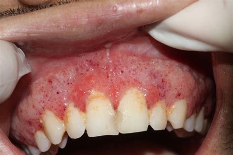 Oral Lesion Of Paracoccidioidomycosis In The Gingiva And Mulberry Like