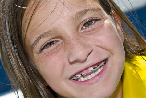 Braces For Kids Whats The Right Age To Start Orthodontia