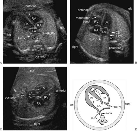 Normal Fetal Heart Ultrasound Ob Images Cardiac Sonog Vrogue Co