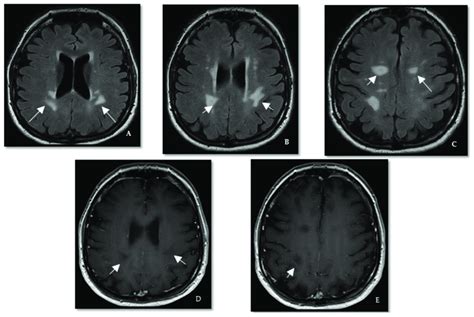 Case Iii A C Axial T2flair Brain Mri Shows Periventricular