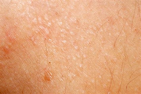 Dry Bumps On Skin Rash How To Choose And Use The Best Moisturizer For