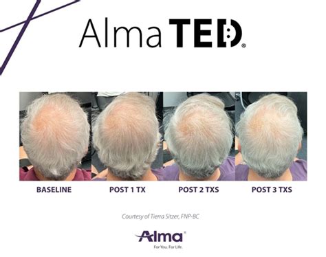 Hair Restoration Henderson Alma Ted Hair Loss Restoration Nv