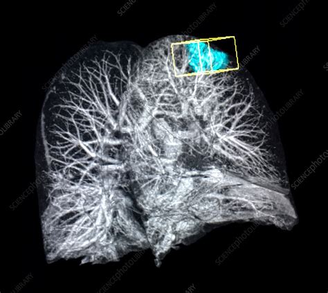 Right Upper Lobe Lung Mass X Ray Stock Image C0394280 Science