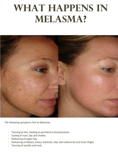 Check spelling or type a new query. The Best Treatment For Melasma