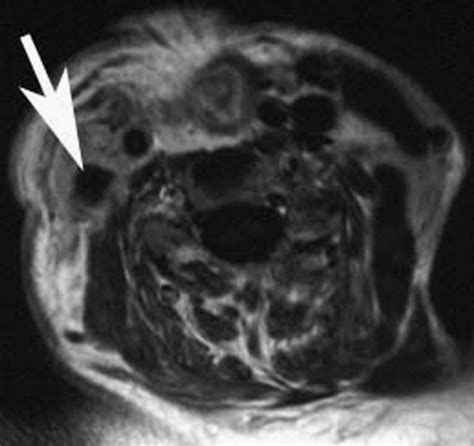 Cervical Lymph Nodes European Journal Of Radiology