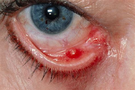 Meibomian Cyst Chalazion On Lower Eyelid Stock Image M1550258