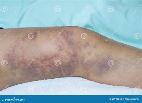 Closeup On A Bruise On Wounded Woman Leg Skin Close Up On A Bruise On