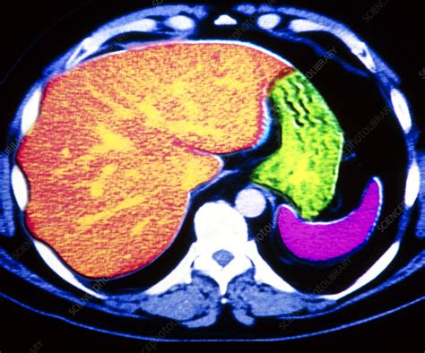 Coloured Ct Scan Of Human Spleen Stomach And Liver Stock