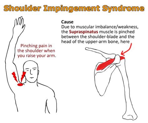 The Diagram Shows How Muscles Should Be Used To Help With Shoulder Pain