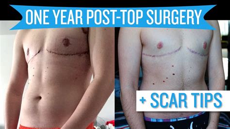 One Year Post Top Surgery Scar Tips YouTube