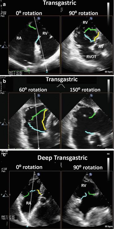Imaging Of The Tricuspid Valve Transoesophageal Echocardiography