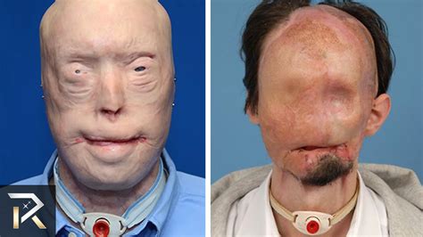10 Most Shocking Transplants Ever Performed On People Youtube
