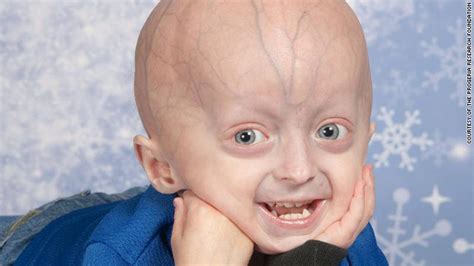 Vishwacare Ayurveda Can Help Progeria Part 1