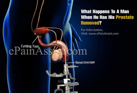 What Side Effects Does Having Your Prostate Removed Bobby Vincents Blog