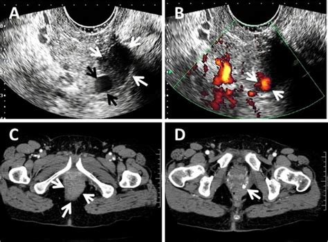 The Successful Detection Of Postpartum Unruptured Vaginal