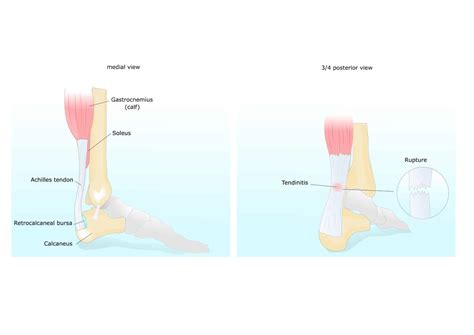 Achilles Tendon Lengthening Surgery Pediatric Foot And Ankle