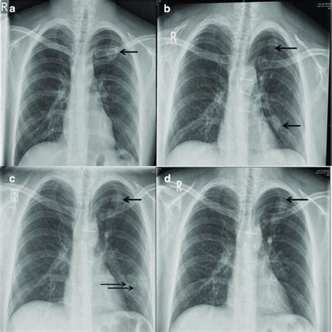 Serial Chest X Rays A Preoperatively In 2014 Showing An Empty Cyst In