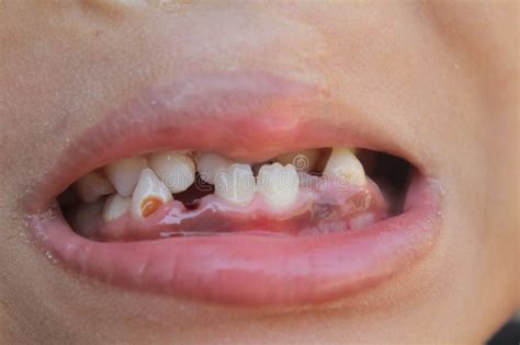 Teeth In Children Cleft Lip Or Cleft Palate That Is Damaged Stock Photo
