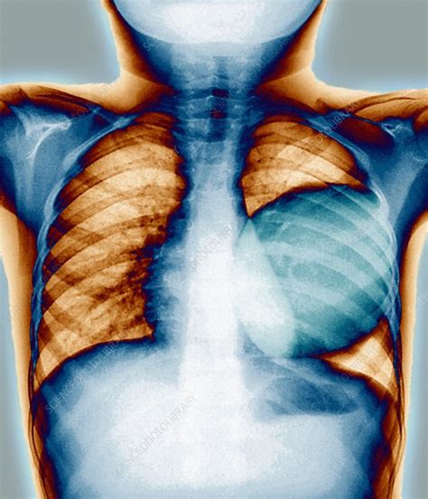 Cyst In A Lung Chest X Ray Stock Image M1700284 Science Photo