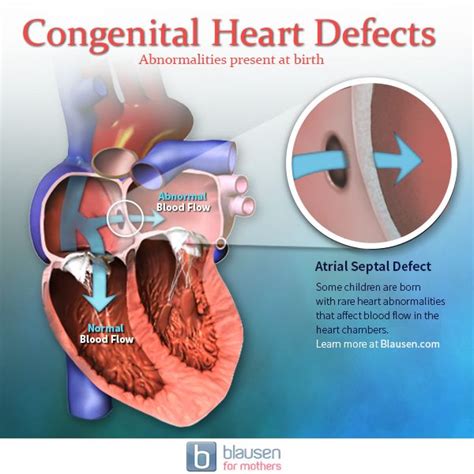 Learn About Anatomy Abnormalities Such As Congenital Heart Defects At