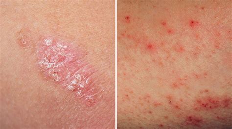 Pruritus In Psoriasis And Atopic Dermatitis Current Treatments And New
