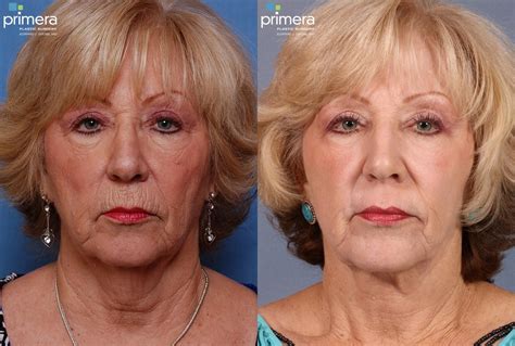 Facelift Before And After Pictures Case 118 Orlando Florida Primera Plastic Surgery