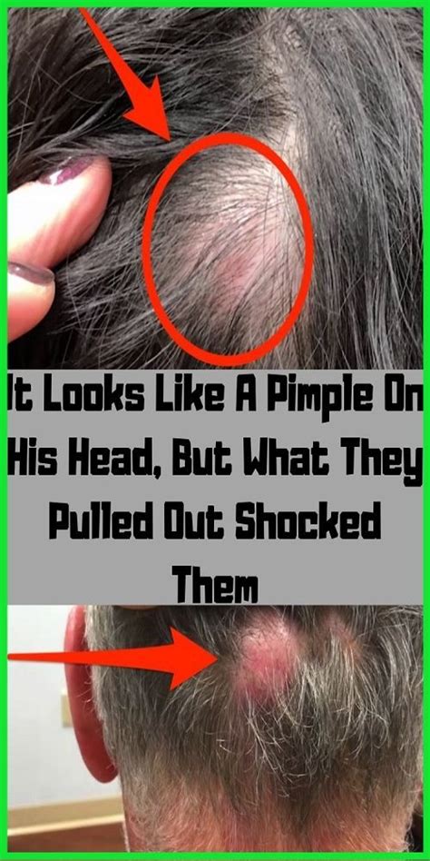 It Looks Like A Pimple On His Head But What They Pulled Out Shocked