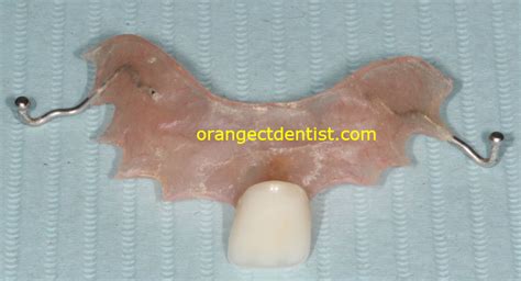 Flipper Single Tooth Partial Denture Dentist Orange Woodbridge Ct