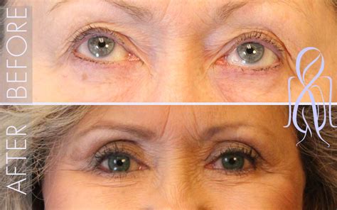 Lower Eyelid Lift Blepharoplasty Eyelid Surgery In Atlanta Ga