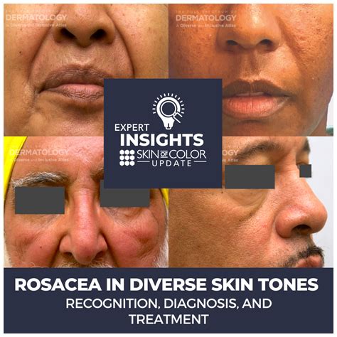 Rosacea In Diverse Skin Tones Recognition Diagnosis And Treatment