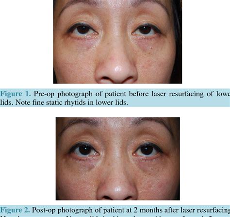 Figure 1 From Periorbital Post Inflammatory Hyperpigmentation After