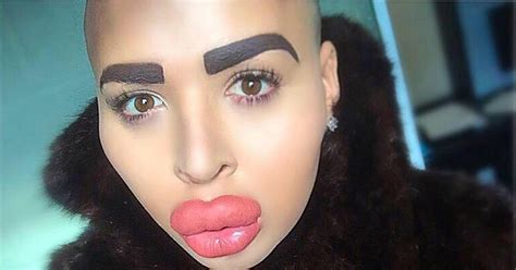 Man Who Inflated Lips To Look Like Kim Kardashian Has Pout Reduced After Face Started Leaking
