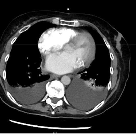 Ct Scan Showing Pleural Effusion And Mitral Annular Calcification
