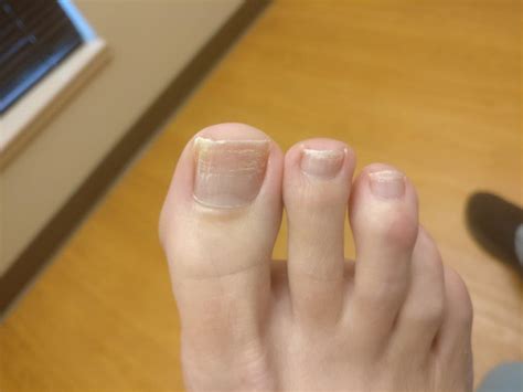 White Discoloration On Toenails After Nail Polish Nail Ftempo