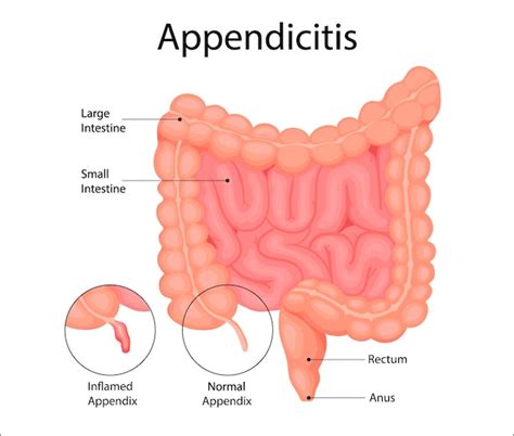 Premium Vector Appendicitis Is An Inflammation Of The Appendix
