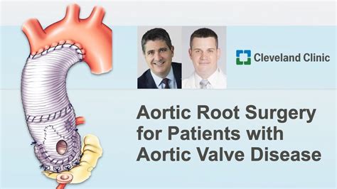 Valve Sparing Aortic Root Replacement Surgeon Roundtable With Dr