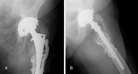 Treatment Of Symptomatic Greater Trochanteric Fracture After Total Hip