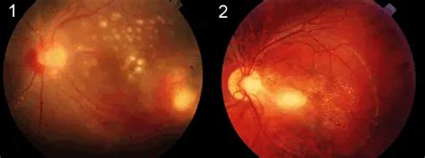 Infectious Uveitis Rule Out The Prime Suspects American Academy Of