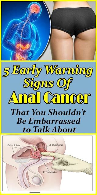 5 Early Warning Signs Anal Cancer That You Shouldnt Be Embarrassed To Talk About Healthy