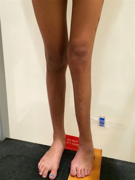 Fibular Hemimelia Leg Lengthening 8 Plate 3 1 2 Months Post Surgery