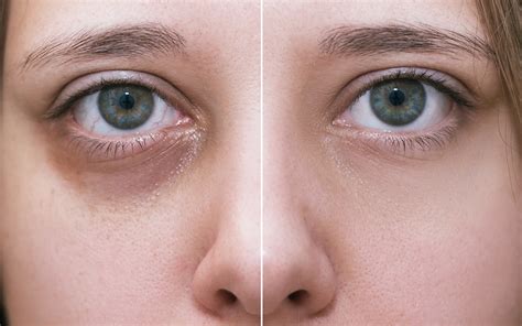 getting rid of dark circles under your eyes we ll help you