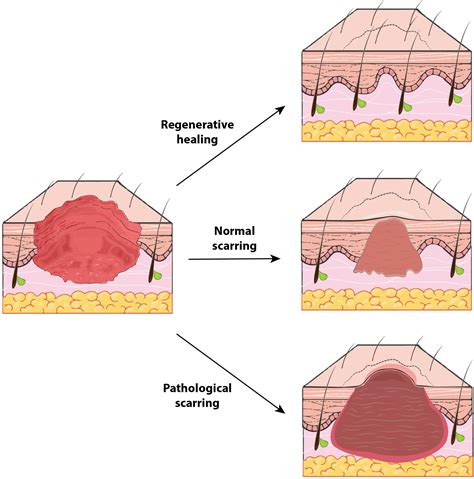 Stages Of Wound Repair