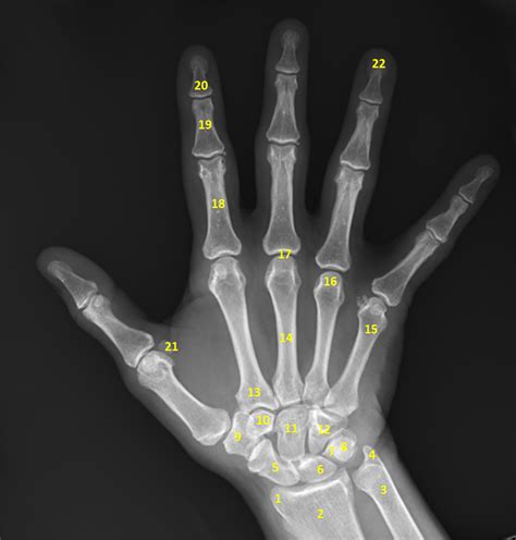 Hand Anatomy Xray Anatomy Diagram Source Images And Photos Finder