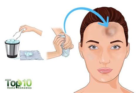 How To Get Rid Of Bumps On Forehead Top 10 Home Remedies Forehead